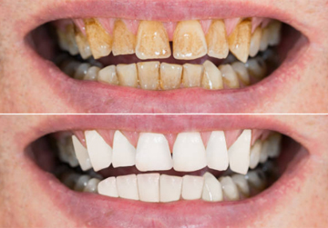 Teeth whitening by Cosmetic Dentist in North York